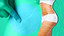 علامات التمدد الاسترتش ماركس علاج أسباب طرق تقليل طرق وقاية