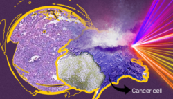 قنبلة-السكر السرطان