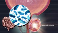 اكتشاف-بكتيريا-تسبب-سرطان-البروستاتا